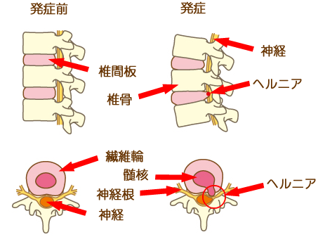 腰椎椎間板ヘルニア