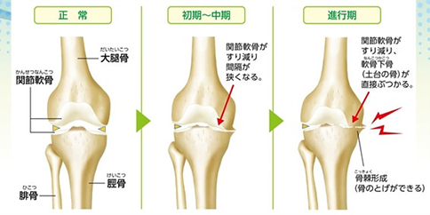 osteoarthritisq_03